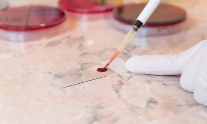 Σε τι διαφέρει η λευχαιμία από το λέμφωμα: Ποια είναι τα ύποπτα συμπτώματα